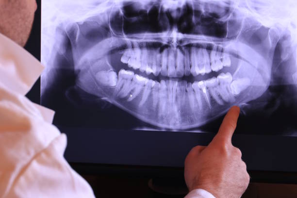 Best Emergency Tooth Extraction in Monticello, KY