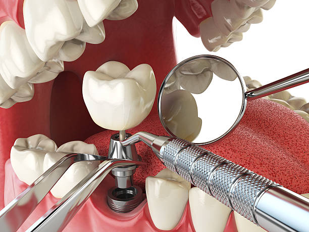 Best Emergency Wisdom Teeth Removal in Monticello, KY